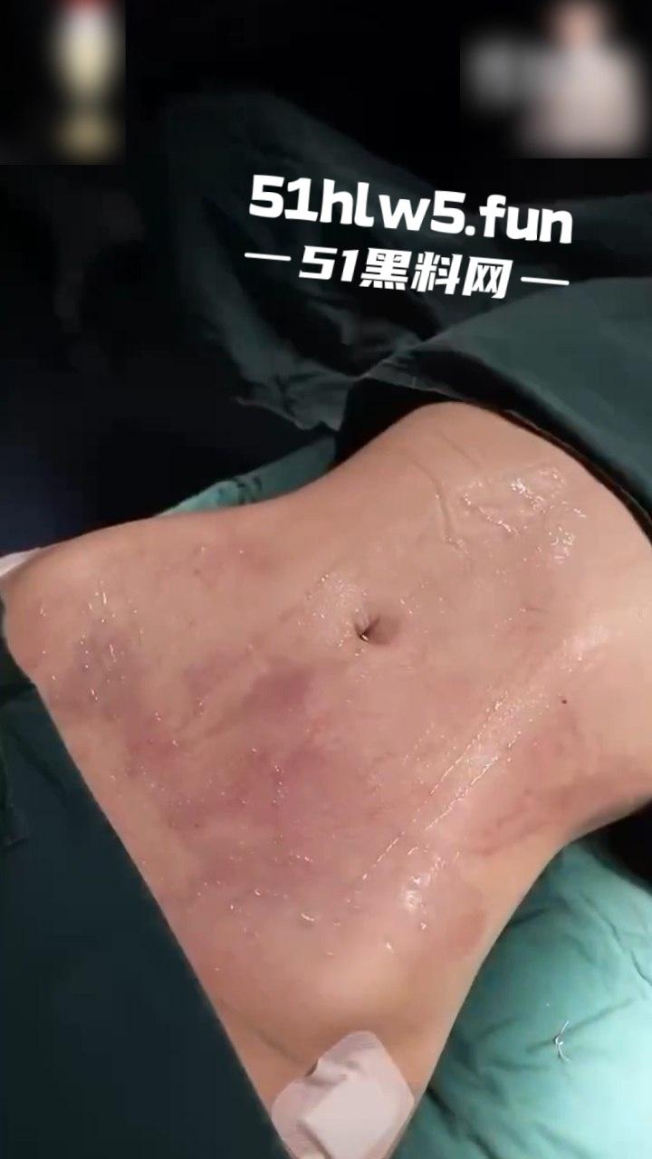 实拍整形医院,小仙女整容抽脂和填充全过程,看着残忍但做完后惊艳的效果让人震撼。-5