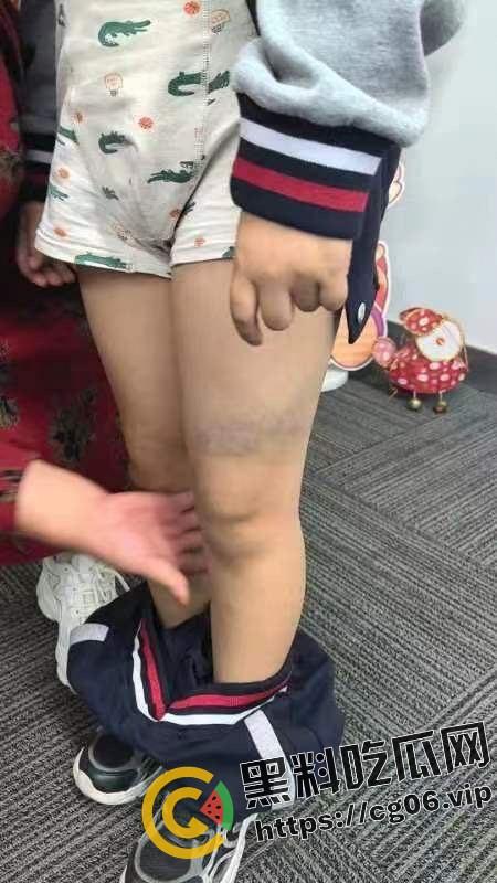 泰州外国语小学老师暴打小学生 全身淤青 家长群内声讨被解散 至今无说法-17