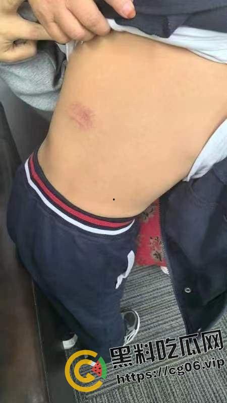 泰州外国语小学老师暴打小学生 全身淤青 家长群内声讨被解散 至今无说法-18