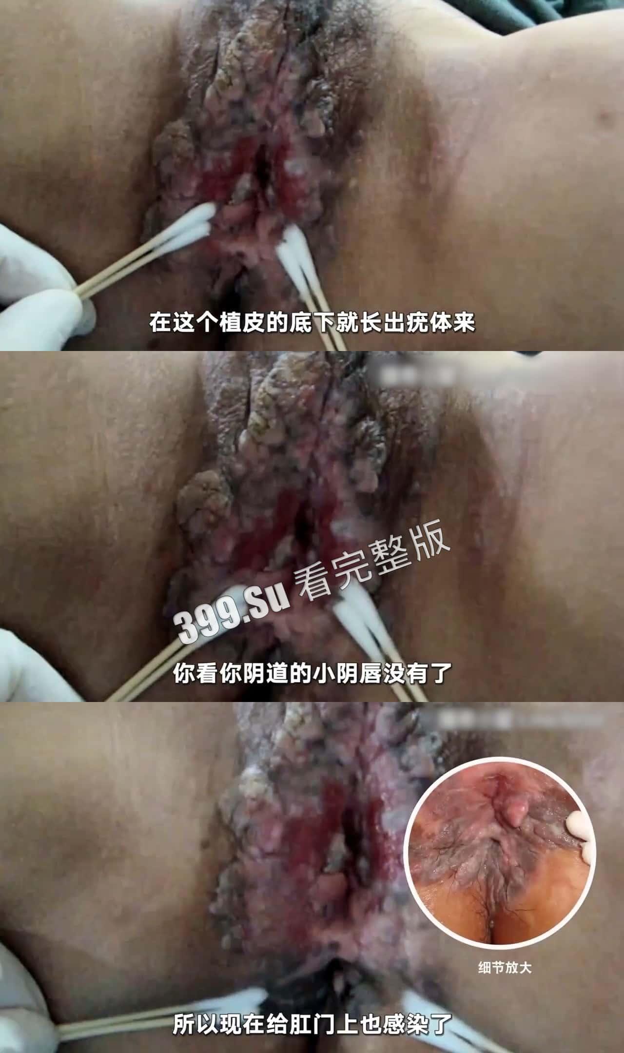 性病篇  谨慎观看！瓜友们出门在外 一定得洁身自爱 世界上没有后悔药  安全第一！！！-1