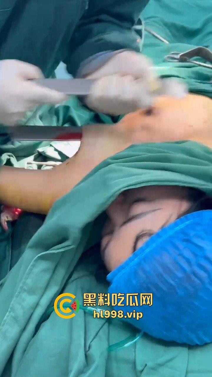 揭秘黄晓明女友『叶柯』同款隆胸术手术过程,看的让人心惊!胸被医生猛戳猛捣,视觉冲击强到不敢看!-6