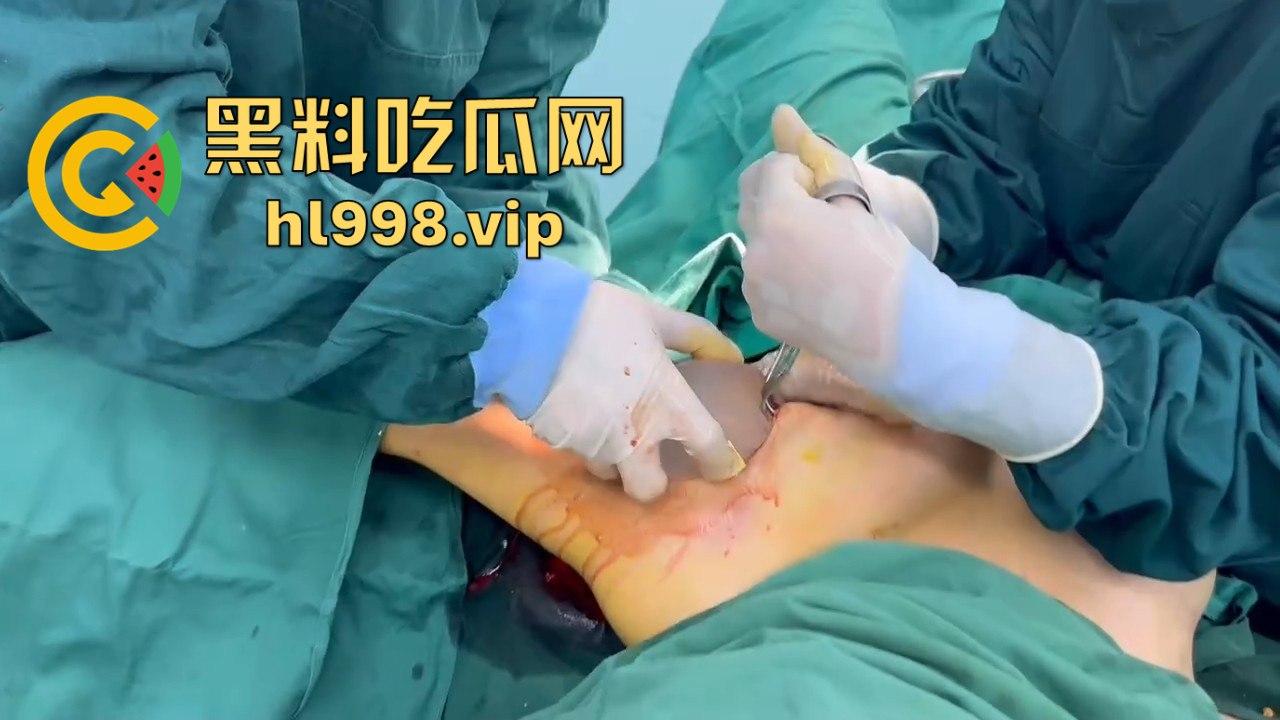 揭秘黄晓明女友『叶柯』同款隆胸术手术过程,看的让人心惊!胸被医生猛戳猛捣,视觉冲击强到不敢看!-7