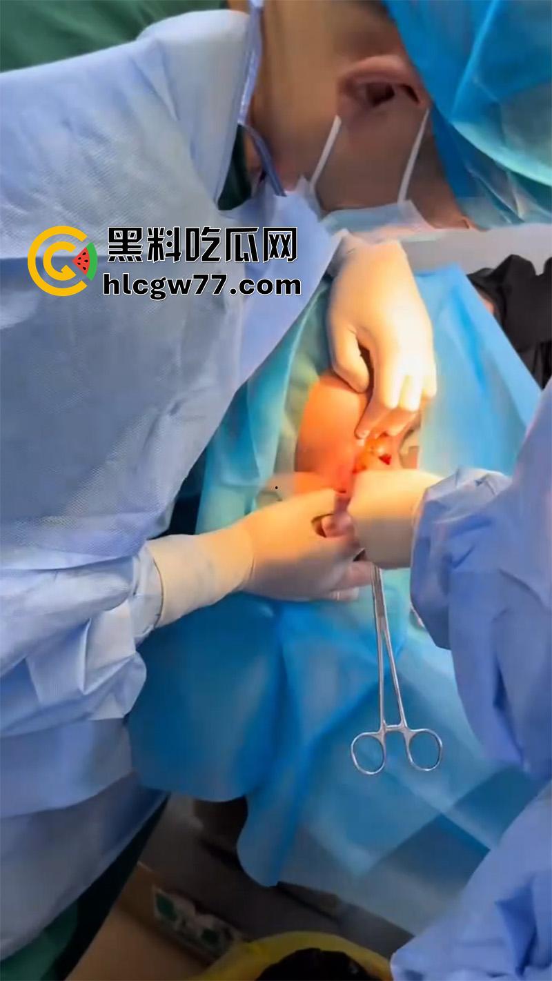 成都肛肠科又来新活，巨屌玩具塞入菊花拔不出来，只能到医院取出，这么大怎么塞进去的呢？-1