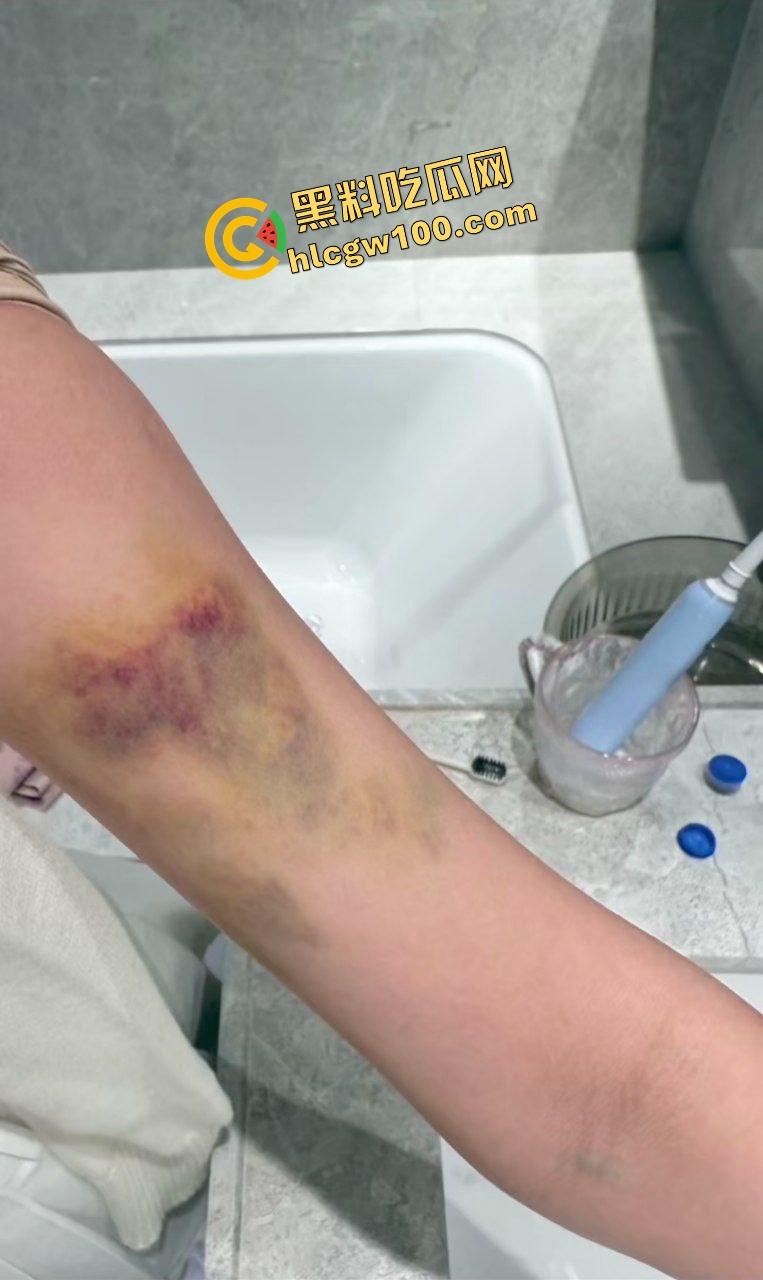 街球圈情侣大瓜！杭州街球手【程鑫凯】家暴女网红【鸡腿诺】多处打伤哭泣现场！独家开盒流出！-17