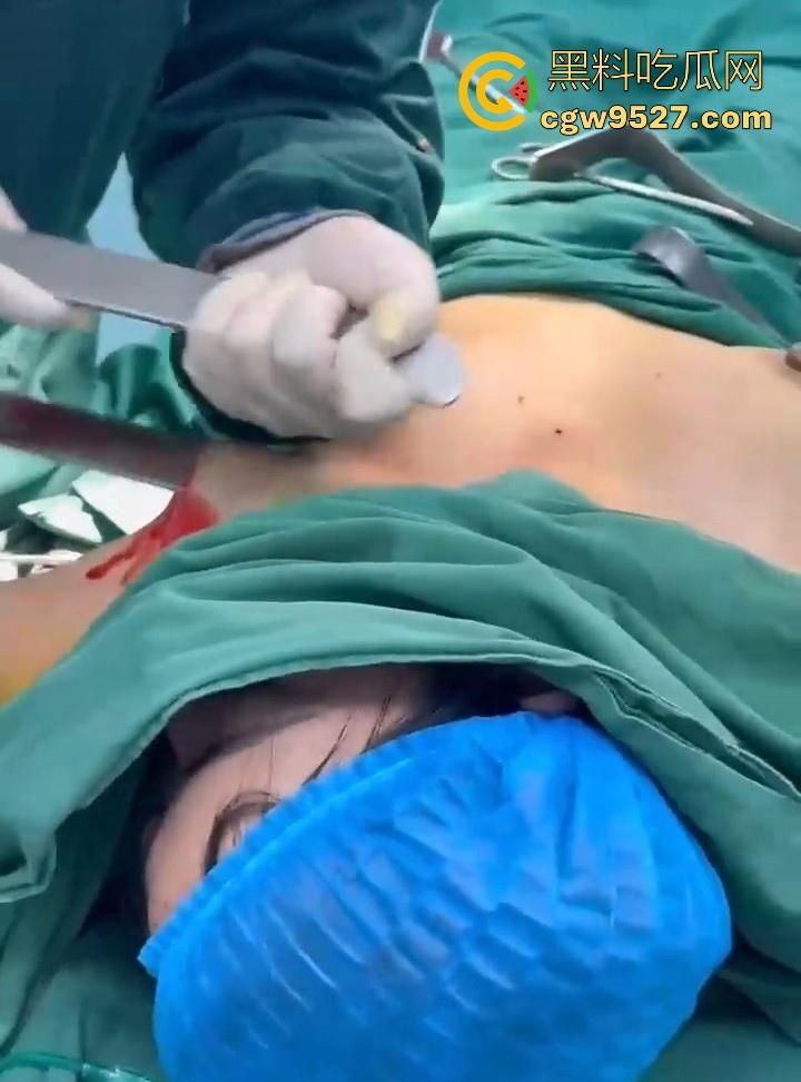 隆胸整形手术现场大曝光！平乳妹秒变巨乳御姐，手术过程一览无遗，女人为变美的代价真大！-3