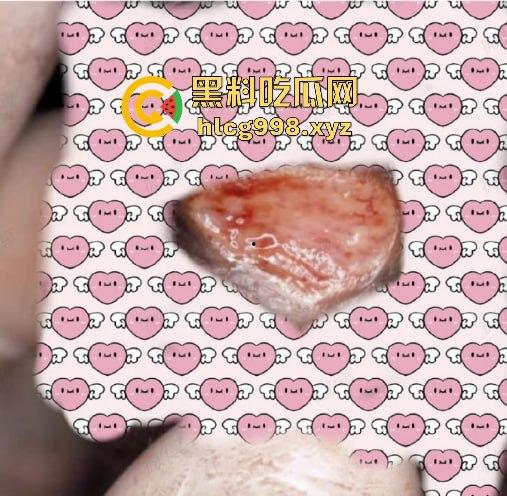 梅毒像疯狗一样乱咬！日本疫情横扫全球，日本卫生部出狠招断根大法安排上，管不住下半身只能禁爱？-4