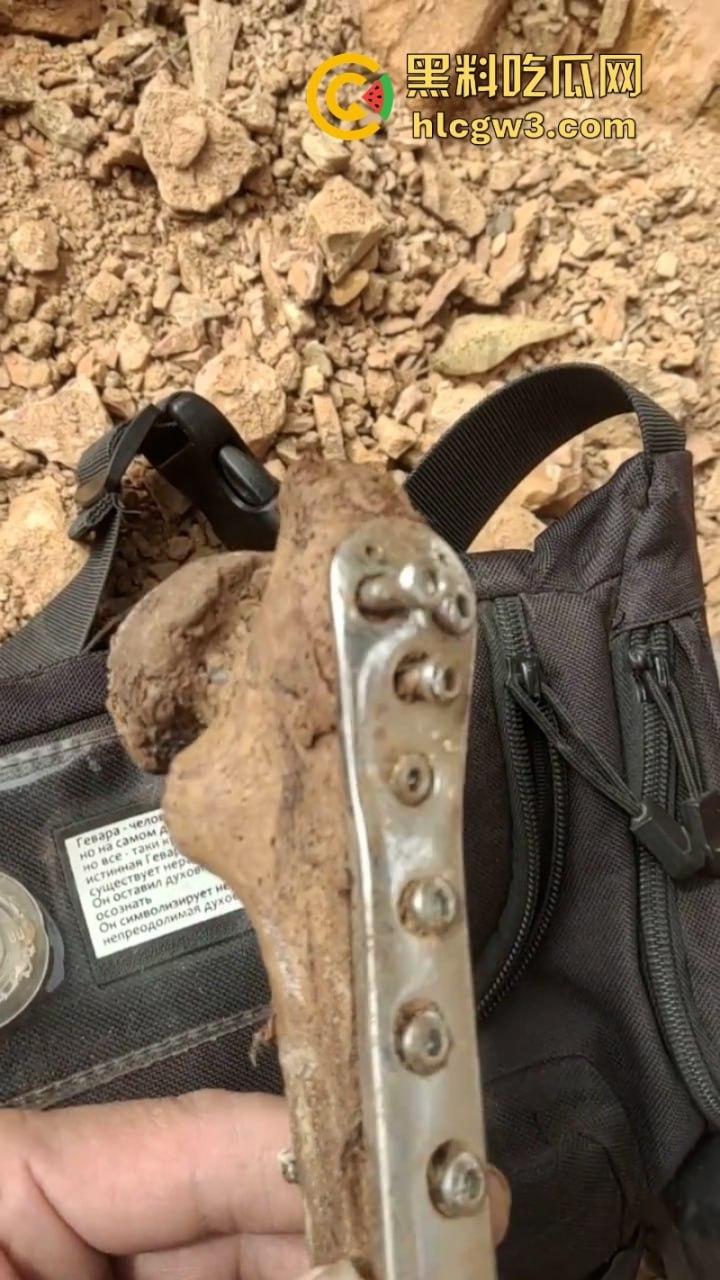 大妈去世后尸骨爆出惊人秘密 广西玉林大化骨科医院恐怖接骨手术让人震惊-4