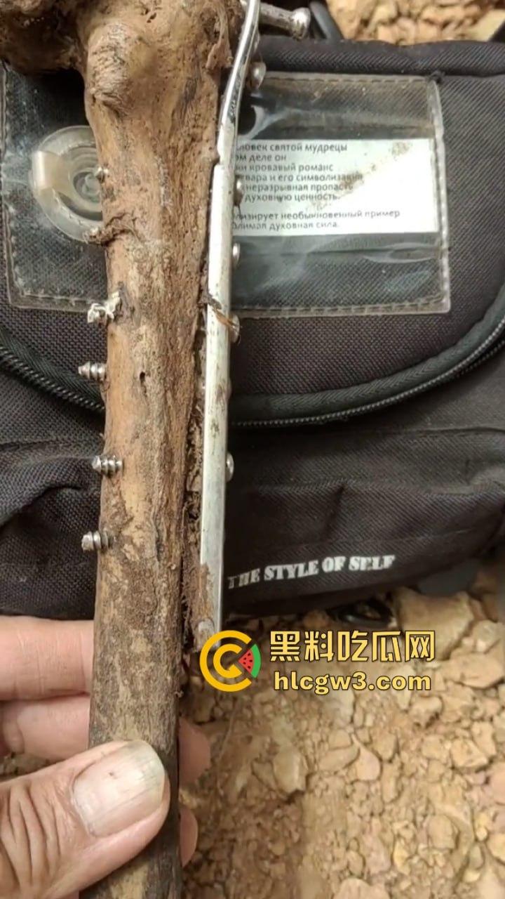 大妈去世后尸骨爆出惊人秘密 广西玉林大化骨科医院恐怖接骨手术让人震惊-7